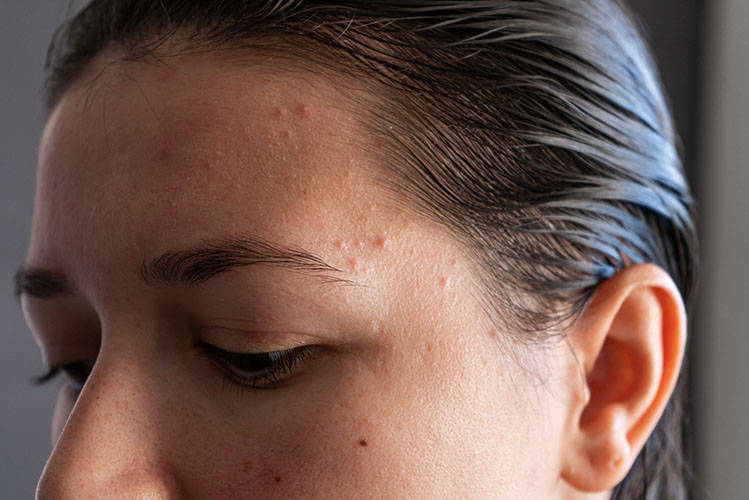 young woman face with acne